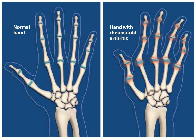 Hand with rheumatoid arthritis