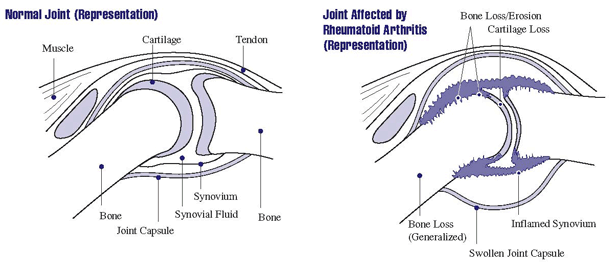 Normal joint and joint affected by RA