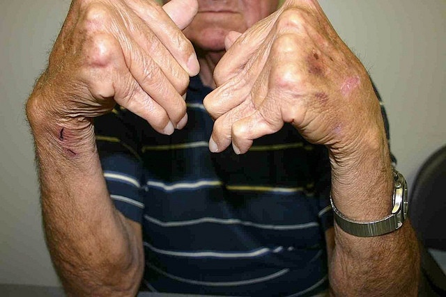 arthritis mutilans