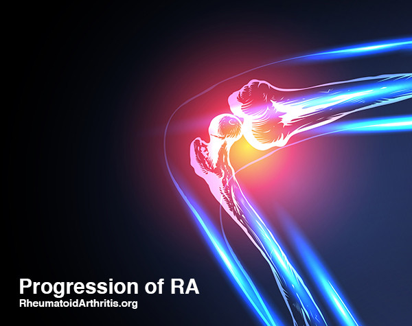 Progression of RA