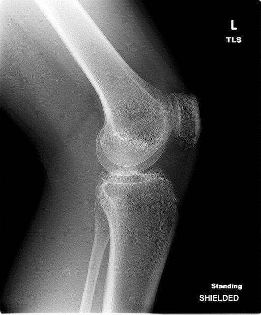 how is arthritis detected on x-ray